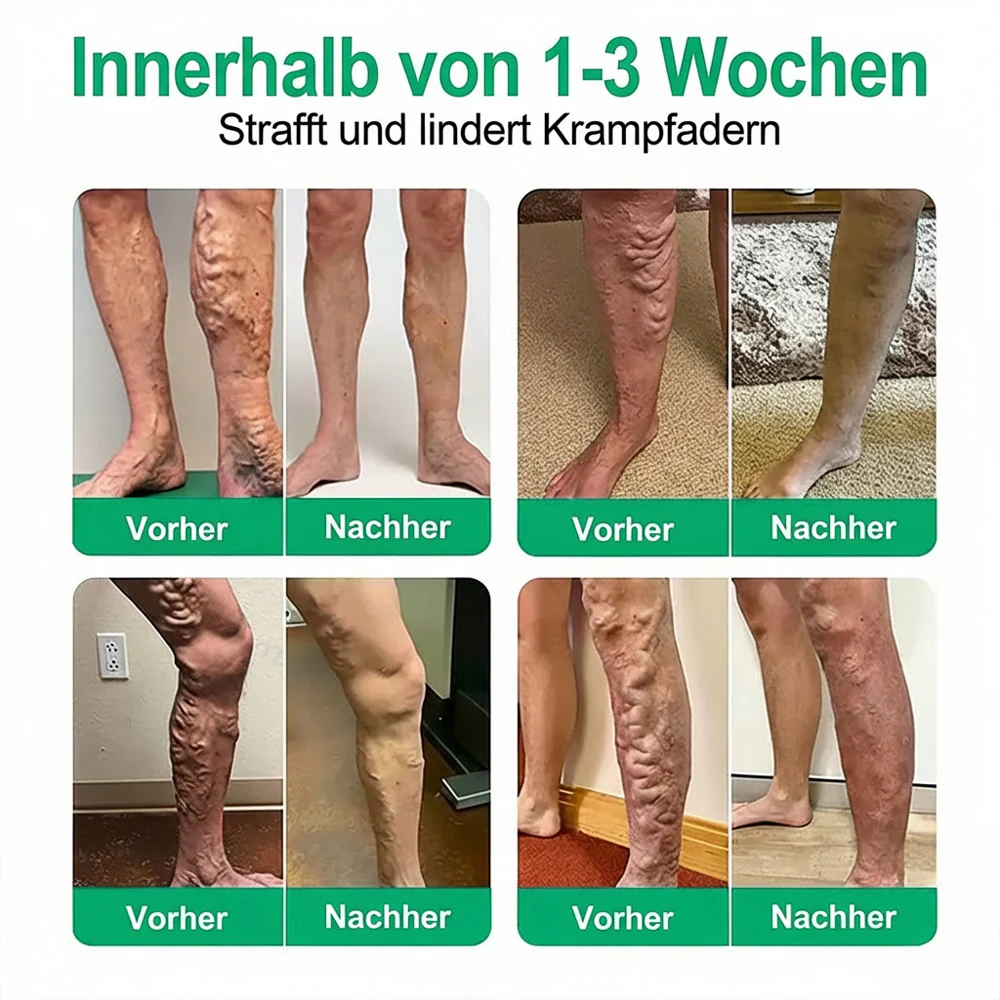 👨‍⚕️🔥Healrize® VeinEase Mikronadel-Technologie⚡Spürbare Wirkung in Tagen – nachhaltige Verbesserung - Image 3