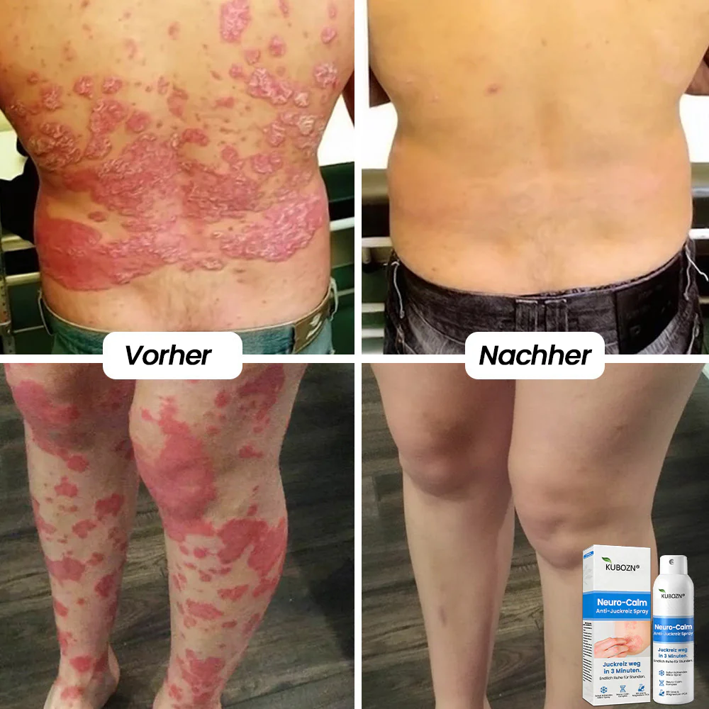 ✅KUBOZN® Neuro-Calm Anti-Juckreiz Akut-Spray – 3-Minuten-Ruhe bei Juckreiz - Image 4