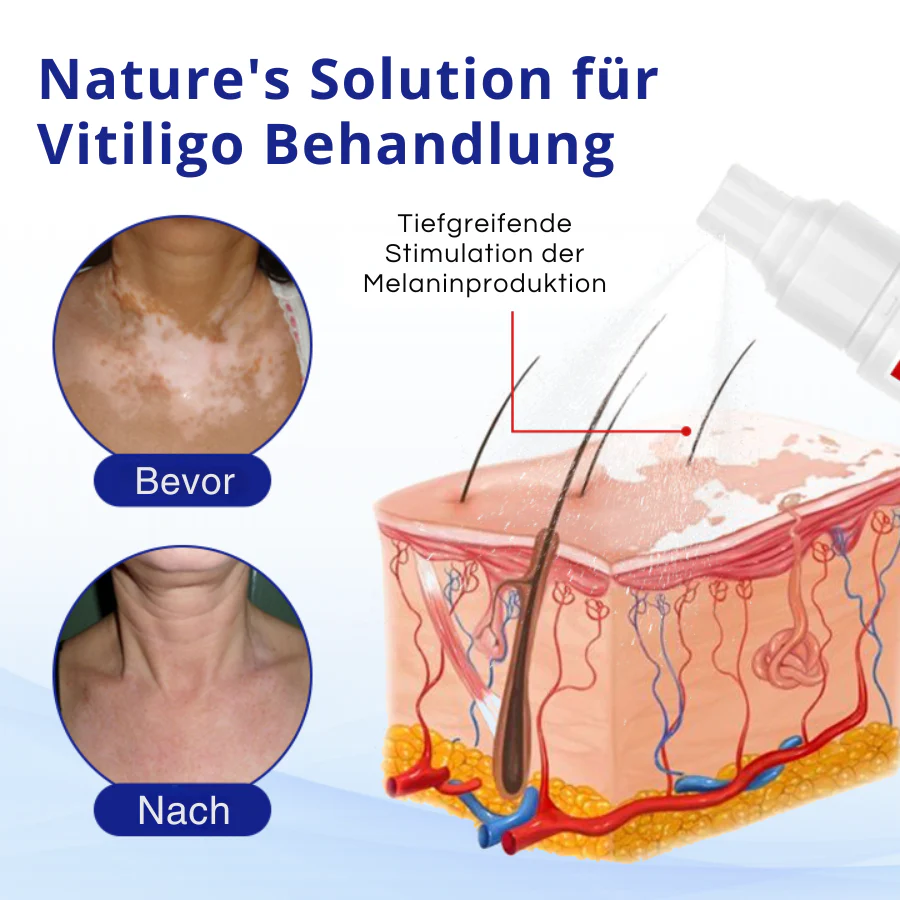 KUBOZN® Spray gegen Vitiligo — Dermatologisch getestet, pflanzlich & steroidfrei  🅱︎ - Image 4