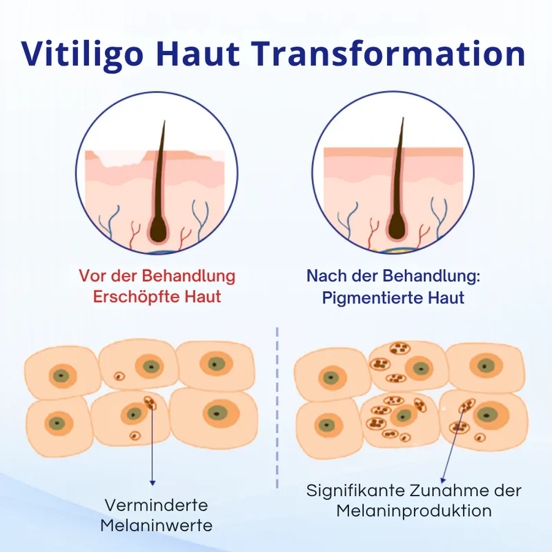 KUBOZN® Spray gegen Vitiligo — Dermatologisch getestet, pflanzlich & steroidfrei  🅱︎ - Image 6
