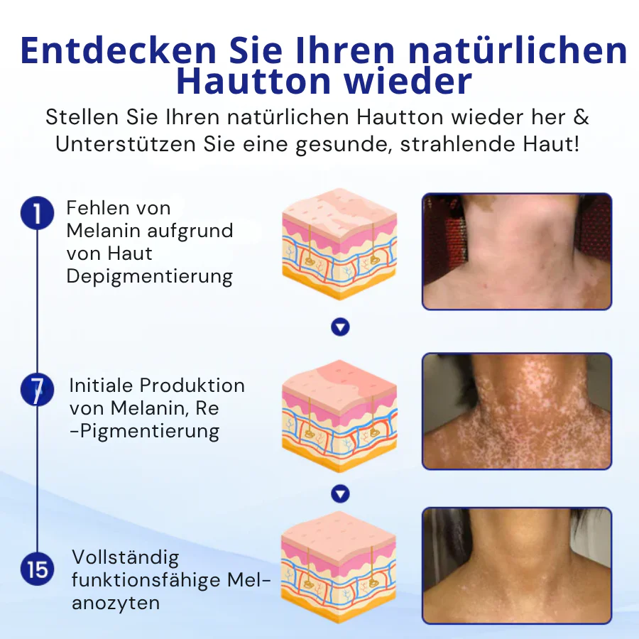 KUBOZN® Spray gegen Vitiligo — Dermatologisch getestet, pflanzlich & steroidfrei  🅱︎ - Image 5