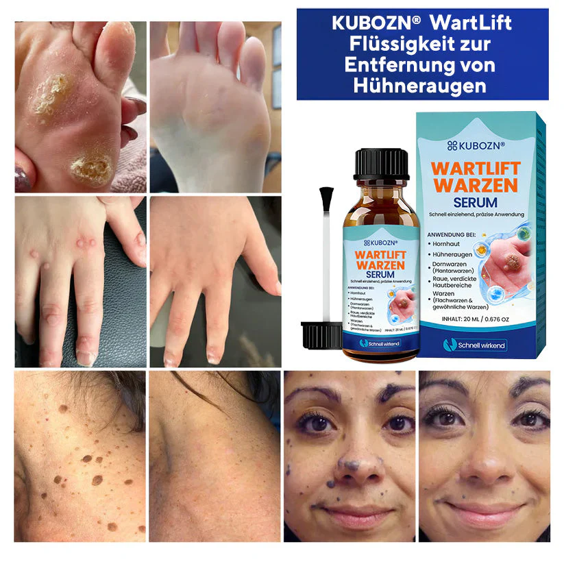 KUBOZN® WartLift Flüssigkeit zur Entfernung von Hühneraugen - Image 2