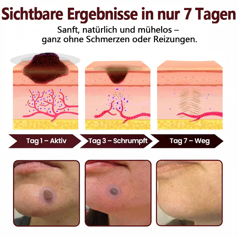 KUBOZN® OryzaDarts TAG’GONE – Schmerzfreie Entfernung an der Wurzel dank Schwarzer-Reis-Mikrotechnologie ✨ - Image 5